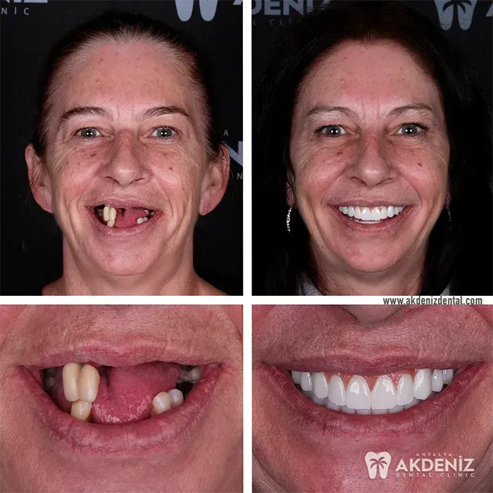 Patient smile before and after dental care in Antalya