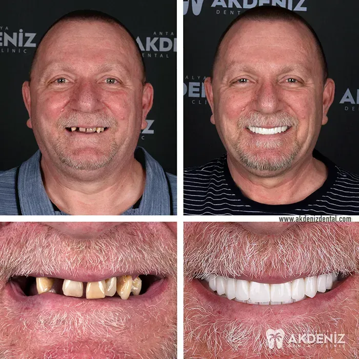 Smile treatment comparison from Akdeniz Dental in Turkey
