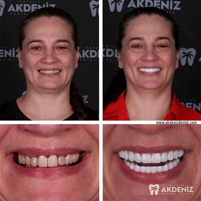 Antalya patient before-and-after dental care result