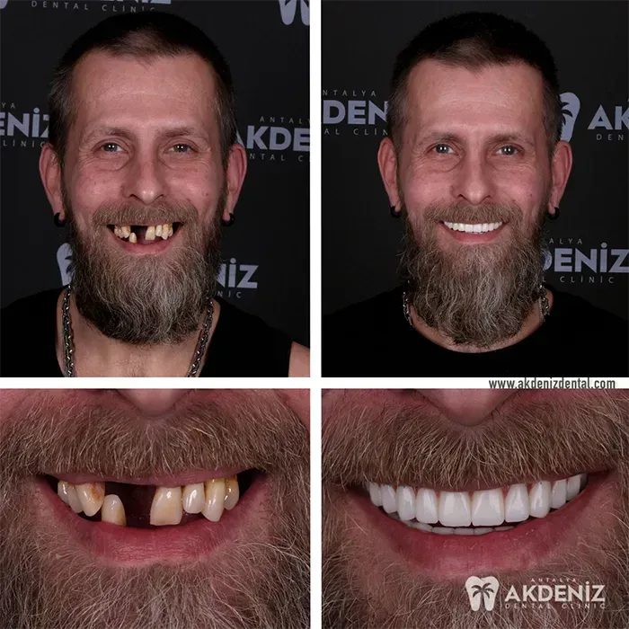 Dental makeover case from our Turkey patient gallery