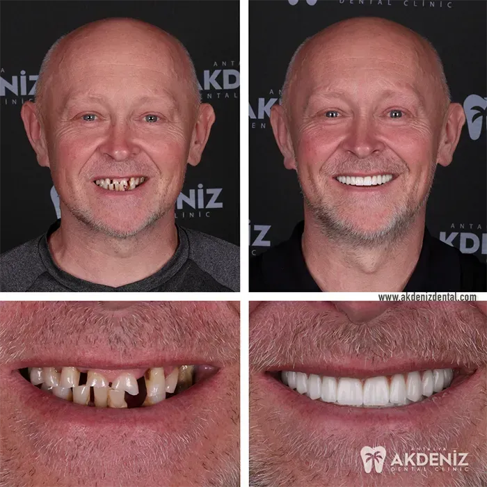 Patient smile restoration by Akdeniz Dental dentists