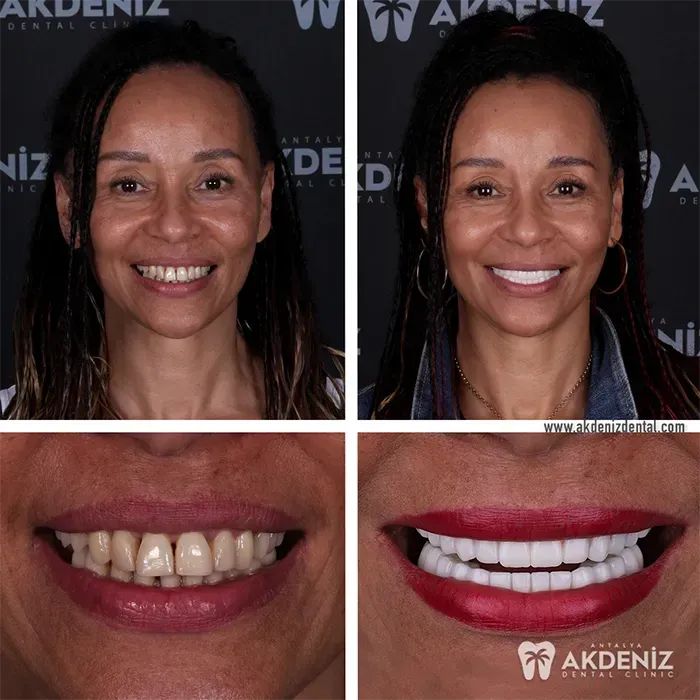 Dental treatment outcome for a patient visiting Antalya