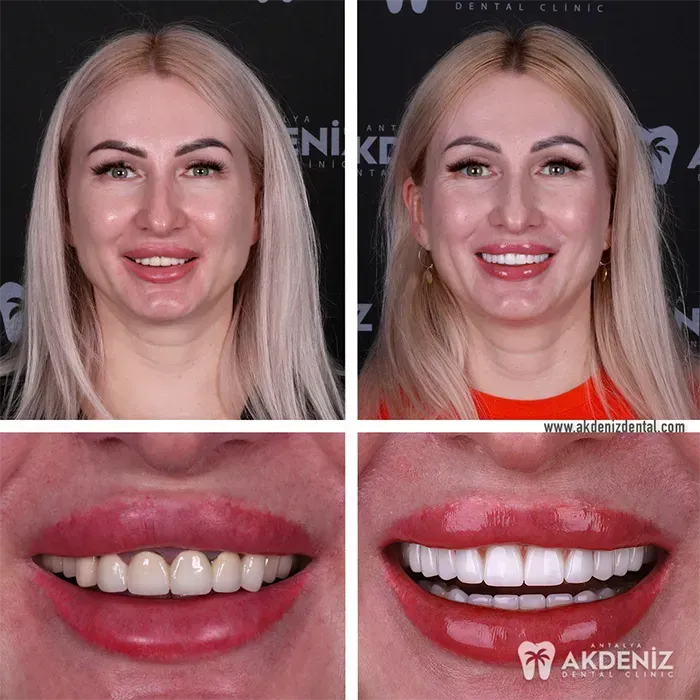 Smile transformation featured by Akdeniz Dental Clinic