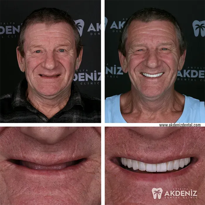 Dental restoration result from our Antalya clinic