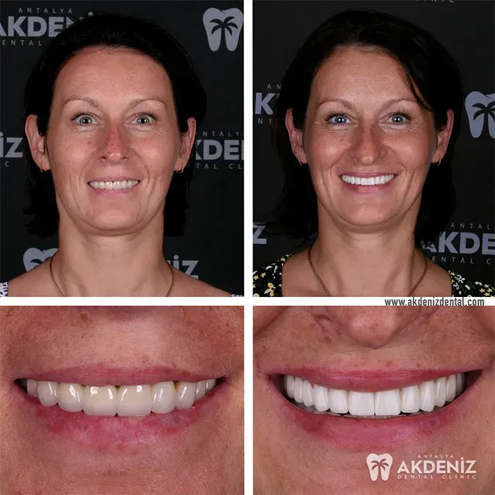 Before-and-after smile treatment at Akdeniz Dental Antalya