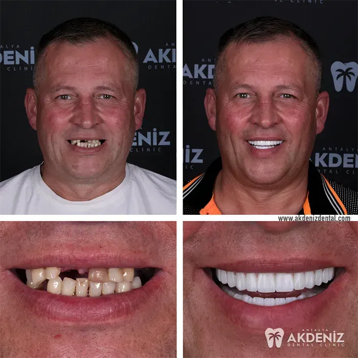 Patient dental treatment comparison in Antalya, Turkey