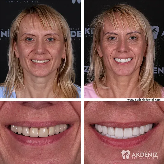 Akdeniz Dental smile care before-and-after example