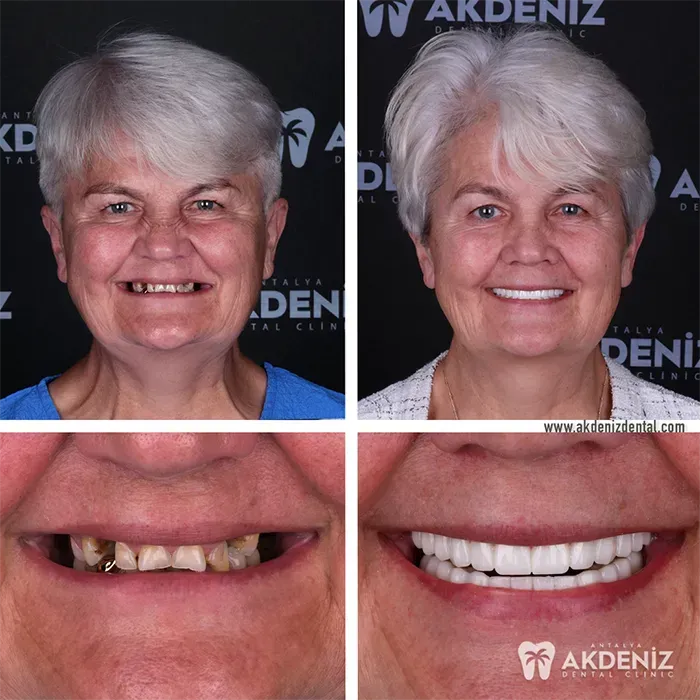 Dental treatment result from our Antalya patient gallery