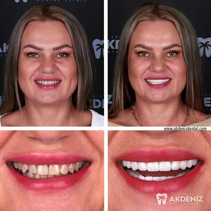 Dental treatment result from an Antalya patient case
