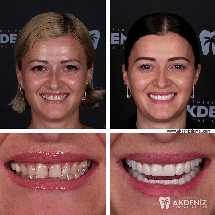 Smile makeover comparison from Akdeniz Dental Antalya
