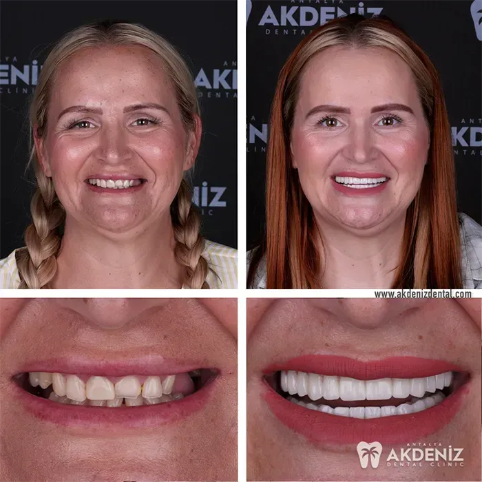 Dental restoration before-and-after patient case in Turkey