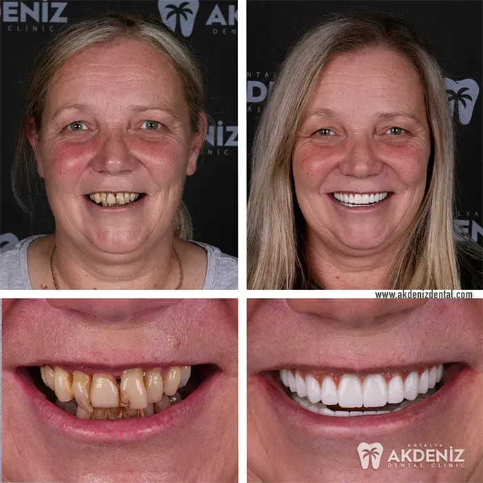 Patient dental care comparison at Akdeniz Dental Clinic