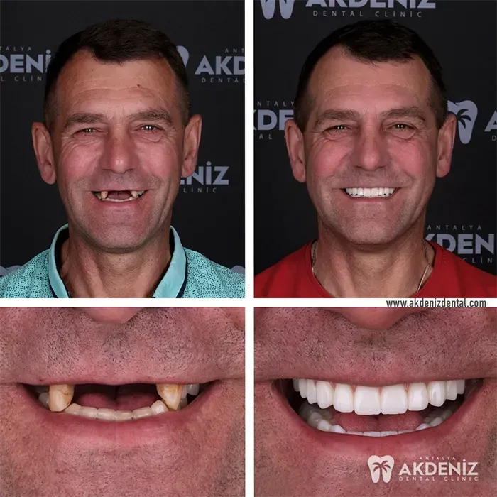 Before-and-after dental treatment photo from Antalya