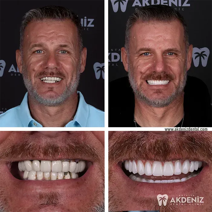 Smile care transformation at a Turkey dental clinic