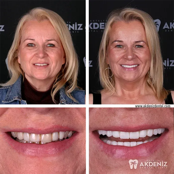 Akdeniz Dental patient smile restoration comparison