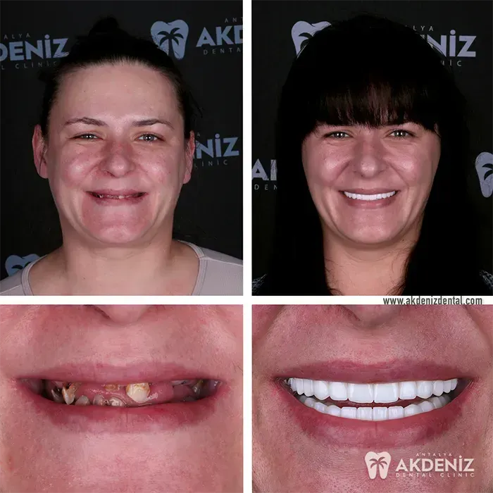 Dental care progress shown in a patient photo